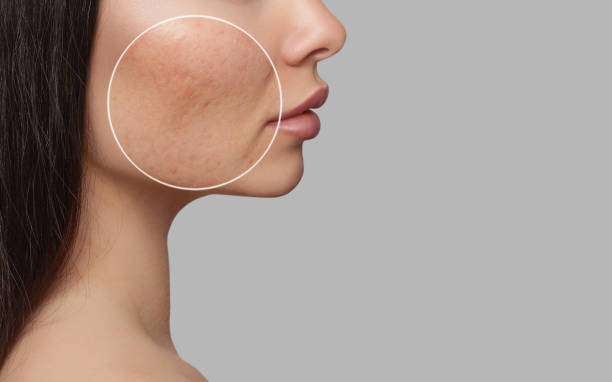 Acne Scar